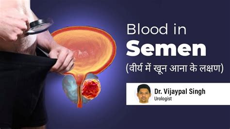 black ejaculation|Blood In Semen (Hematospermia): Causes & Treatment.